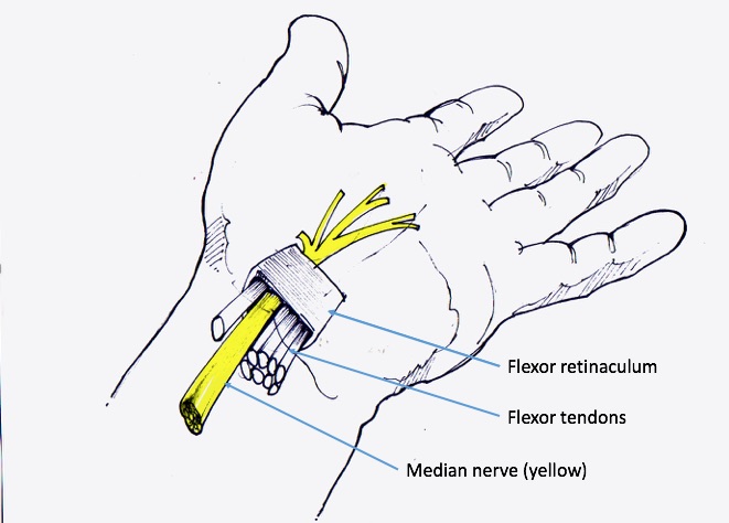 Carpal tunnel syndrome  The British Society for Surgery of the Hand